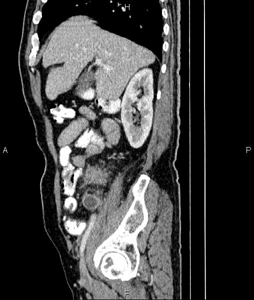 File:Cecal cancer with appendiceal mucocele (Radiopaedia 91080-108651 E 28).jpg