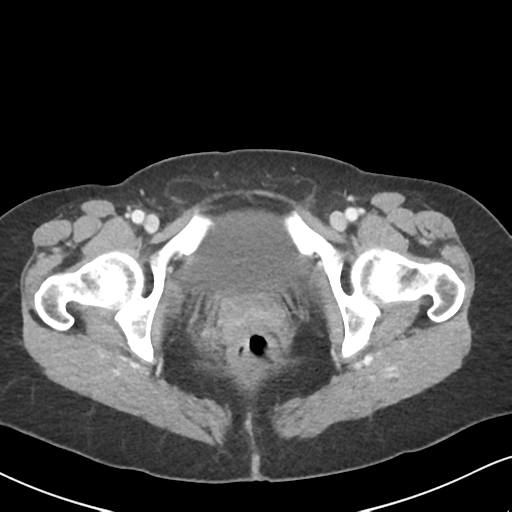 Cecal internal hernia through the foramen of Winslow (Radiopaedia 44820-48651 B 76).png