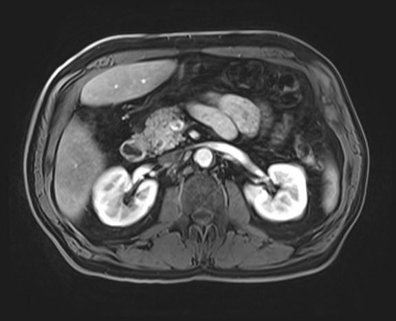 Cecal mass causing appendicitis (Radiopaedia 59207-66532 H 56).jpg