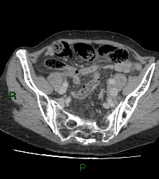 Cecal volvulus (Radiopaedia 86741-102900 A 102).jpg