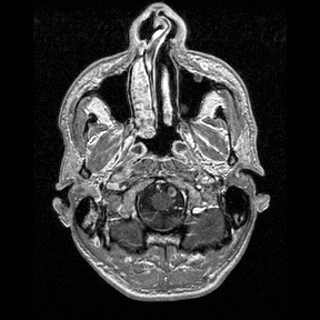 Central-variant posterior reversible encephalopathy syndrome (PRES) (Radiopaedia 43880-47358 Axial T1 C+ 5).jpg