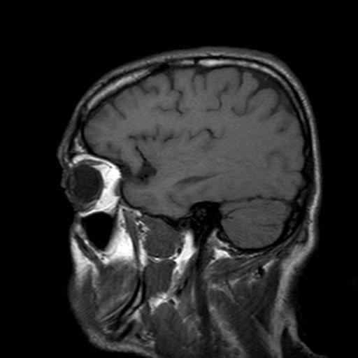 File:Central-variant posterior reversible encephalopathy syndrome (PRES) (Radiopaedia 43880-47359 Sagittal T1 5).jpg