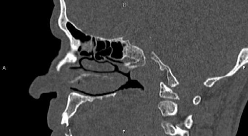File:Central giant cell granuloma (Radiopaedia 83346-97761 Sagittal bone window 28).jpg