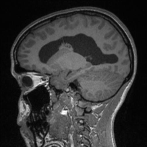 Central neurocytoma (Radiopaedia 37664-39557 Sagittal T1 37).png