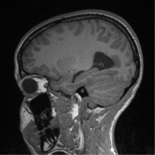 Central neurocytoma (Radiopaedia 37664-39557 Sagittal T1 66).png