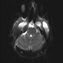 Central neurocytoma (Radiopaedia 56690-63469 Axial DWI 4).jpg