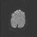 Central neurocytoma (Radiopaedia 56690-63469 Axial DWI 56).jpg