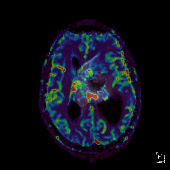 File:Central neurocytoma (Radiopaedia 84497-99872 Axial Perfusion 140).jpg