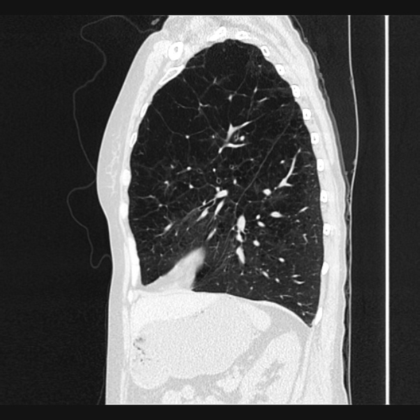 Centrilobular pulmonary emphysema (Radiopaedia 24495-24789 Sagittal lung window 59).jpg