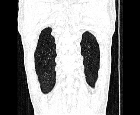 Centrilobular pulmonary emphysema (Radiopaedia 62468-70718 Coronal lung window 67).jpg