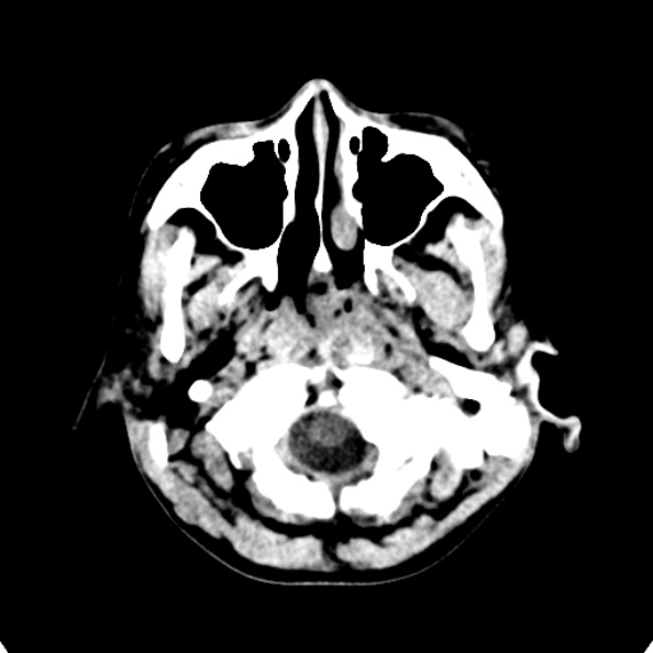 Cerebellar abscess secondary to mastoiditis (Radiopaedia 26284-26412 Axial non-contrast 10).jpg