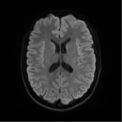 Cerebellar agenesis with hypoplastic pons (pontocerebellar hypoplasia) (Radiopaedia 57224-64138 Axial DWI 59).png
