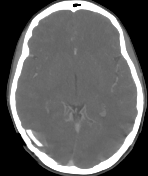 Cerebellar arteriovenous malformation- with hemorrhage (Radiopaedia 35752-37297 B 25).png