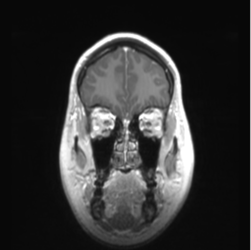 Cerebellar ependymoma complicated by post-operative subdural hematoma (Radiopaedia 83322-97736 Coronal T1 C+ 11).png