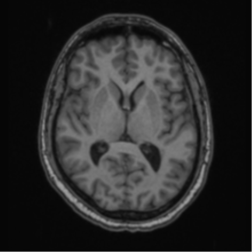 Cerebellar hemangioblastomas and pituitary adenoma (Radiopaedia 85490-101176 Axial T1 39).png