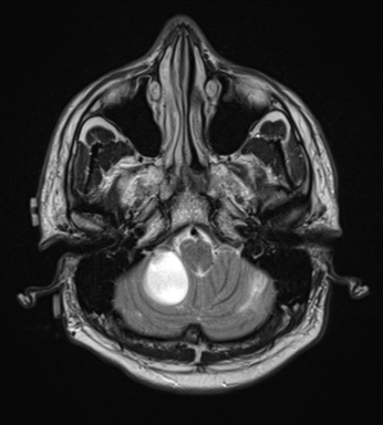 File:Cerebellar hemangioblastomas and pituitary adenoma (Radiopaedia 85490-101176 Axial T2 6).png