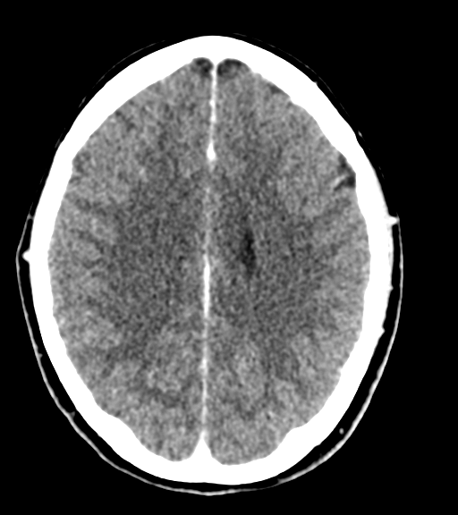 Cerebellar metastases - colorectal adenocarcinoma (Radiopaedia 40947-43652 Axial C+ 41).png