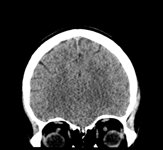 Cerebellar metastases - colorectal adenocarcinoma (Radiopaedia 40947-43652 Coronal non-contrast 28).png