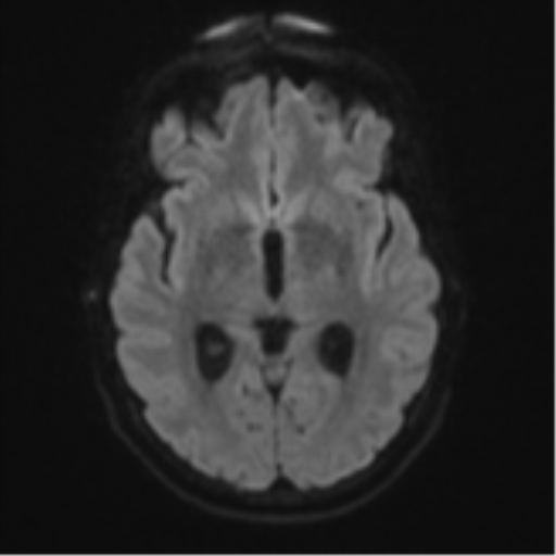 Cerebellar metastasis (Radiopaedia 51137-56765 Axial DWI 42).png