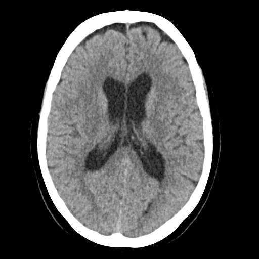 Cerebellar metastasis (Radiopaedia 54578-60812 Axial non-contrast 28).png