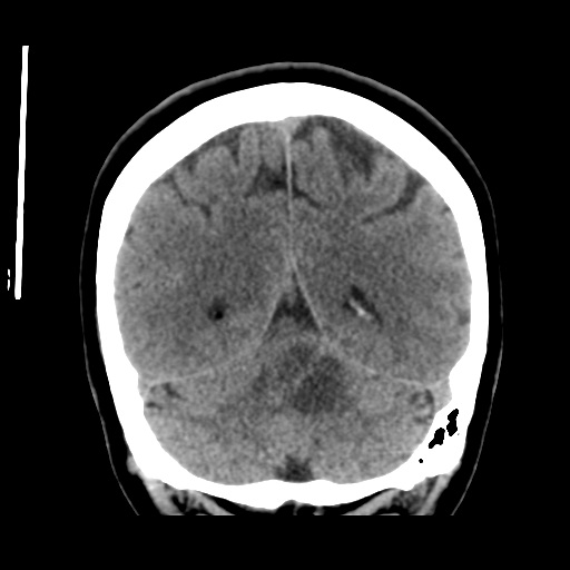 Cerebellar metastasis (cystic appearance) (Radiopaedia 41395-44258 Coronal non-contrast 45).png