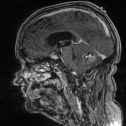 Cerebellar metastasis from lung adenocarcinoma (Radiopaedia 86690-102829 Sagittal T1 C+ 39).png