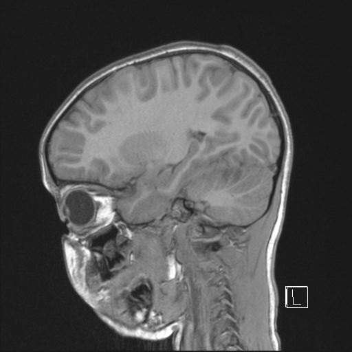 Cerebellar stroke (Radiopaedia 32202-33150 Sagittal T1 C+ 17).png