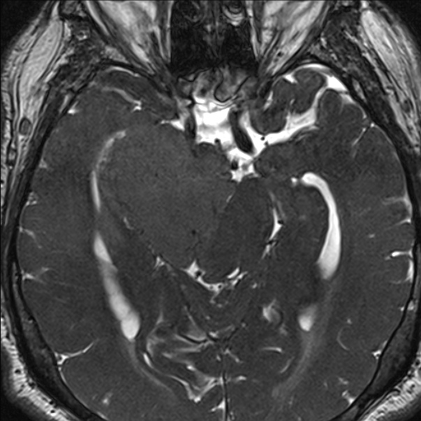 Cerebellopontine angle meningioma (Radiopaedia 24459-24764 I 38).jpg