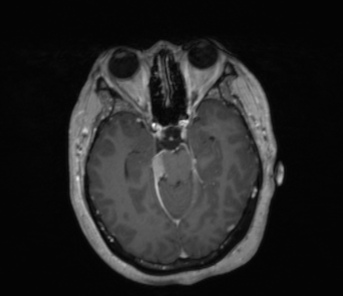 Cerebellopontine angle meningioma (Radiopaedia 35181-36715 Axial T1 C+ 35).jpg