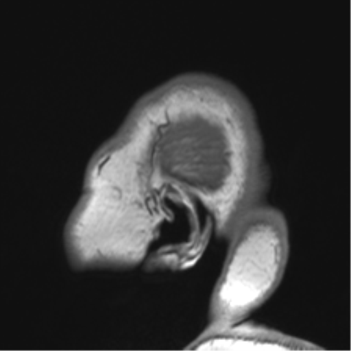 Cerebellopontine angle meningioma (Radiopaedia 48434-53348 Sagittal T1 7).png