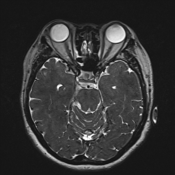 Cerebellopontine angle meningioma (Radiopaedia 53561-59591 Axial 3D volume T2 89).jpg