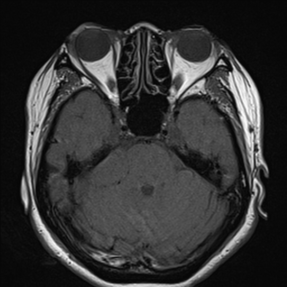 File:Cerebellopontine angle meningioma (Radiopaedia 53561-59591 Axial T1 14).jpg