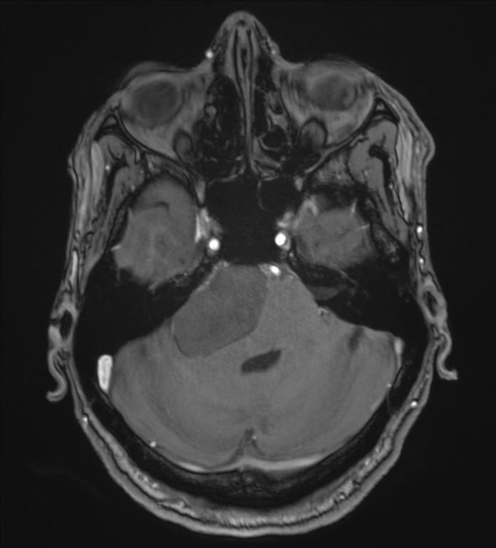 Cerebellopontine angle meningioma (Radiopaedia 72983-83680 Axial MRA 30).jpg