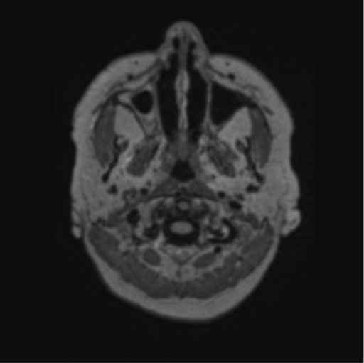 Cerebral abscess from pulmonary arteriovenous malformation (Radiopaedia 86275-102291 J 4).png