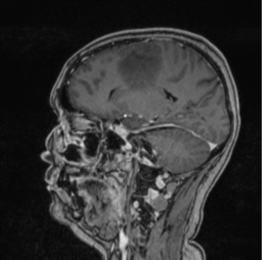 Cerebral abscess from pulmonary arteriovenous malformation (Radiopaedia 86275-102291 Sagittal T1 C+ 47).png