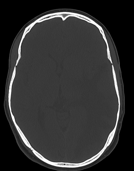 Cerebral abscesses (Radiopaedia 70458-80568 Axial bone window 31).jpg