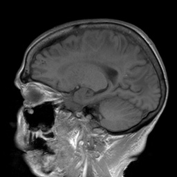 File:Cerebral amyloid angiopathy-related inflammation (Radiopaedia 74836-85849 Sagittal T1 22).jpg