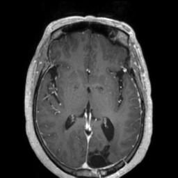 Cerebral amyloid angiopathy (Radiopaedia 29129-29518 Axial T1 C+ 76).jpg