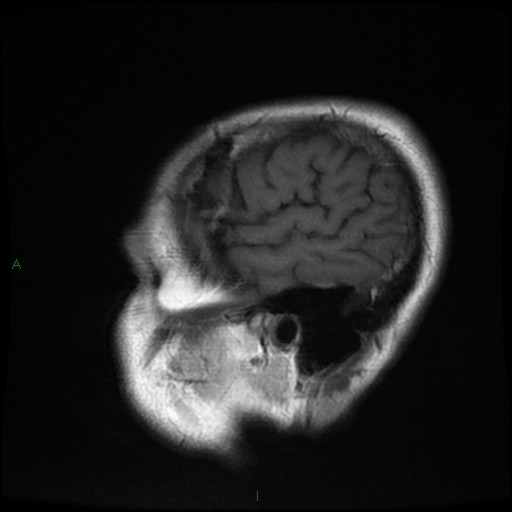 File:Cerebral amyloid angiopathy (Radiopaedia 77506-89664 Coronal T1 4).jpg