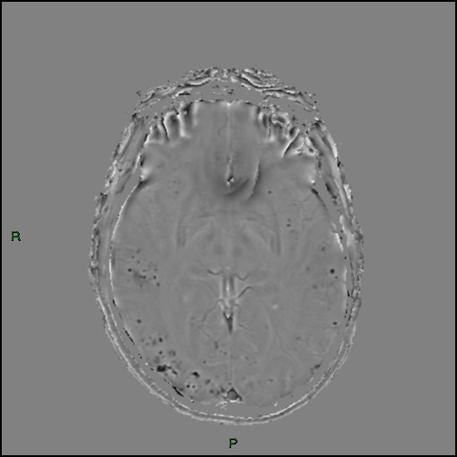 Cerebral amyloid angiopathy (Radiopaedia 77506-89664 H 50).jpg
