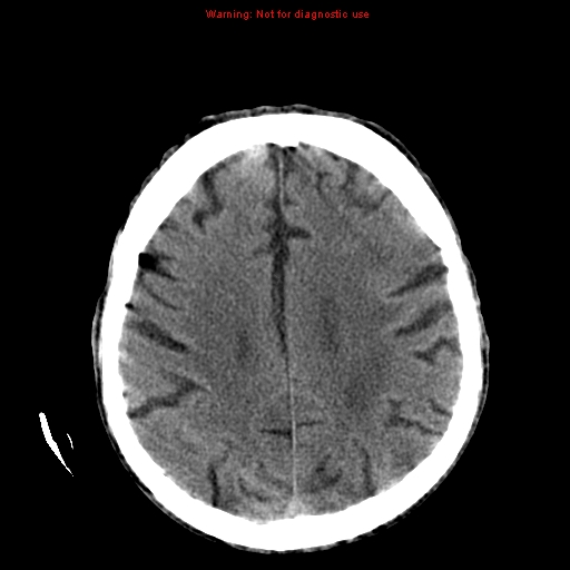 File:Cerebral and orbital tuberculomas (Radiopaedia 13308-13310 Axial non-contrast 20).jpg