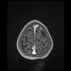 Cerebral and spinal tuberculosis (Radiopaedia 90489-107837 Axial T1 C+ 172).jpg
