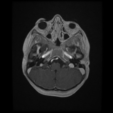 Cerebral and spinal tuberculosis (Radiopaedia 90489-107837 Axial T1 C+ 52).jpg