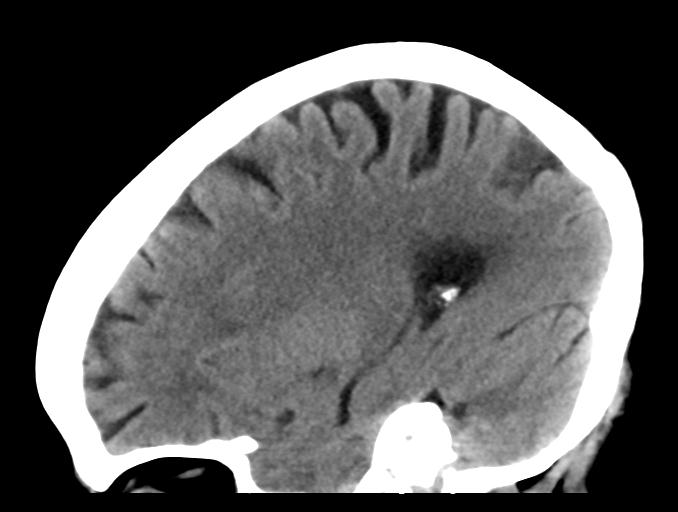 File:Cerebral aneurysm with rupture (Radiopaedia 29933-30457 B 10).jpg