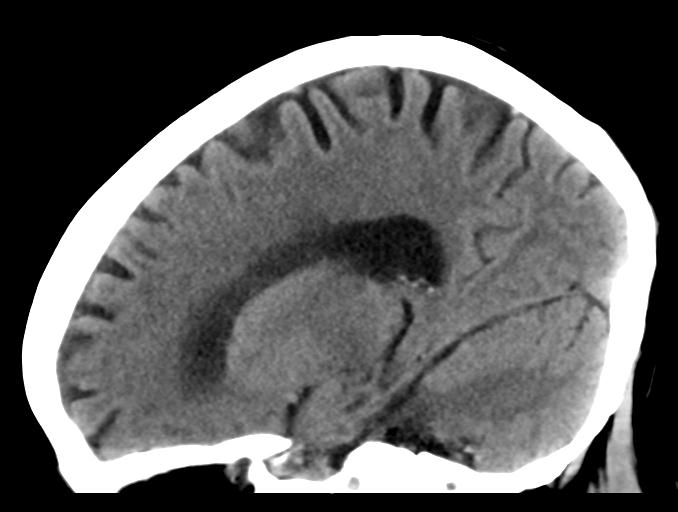 File:Cerebral aneurysm with rupture (Radiopaedia 29933-30457 B 19).jpg