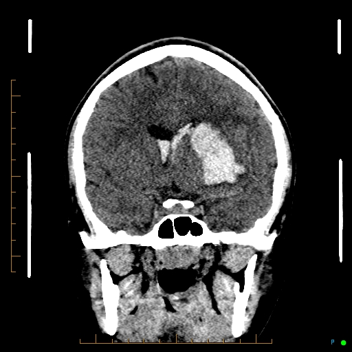 File:Cerebral arteriovenous malformation (AVM) (Radiopaedia 78162-90706 Coronal non-contrast 43).jpg