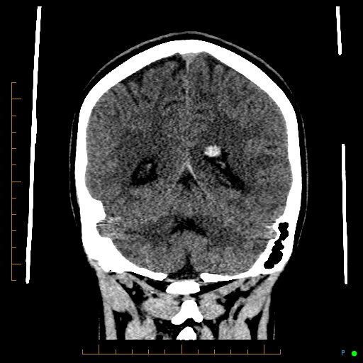 File:Cerebral arteriovenous malformation (AVM) (Radiopaedia 78162-90706 Coronal non-contrast 69).jpg