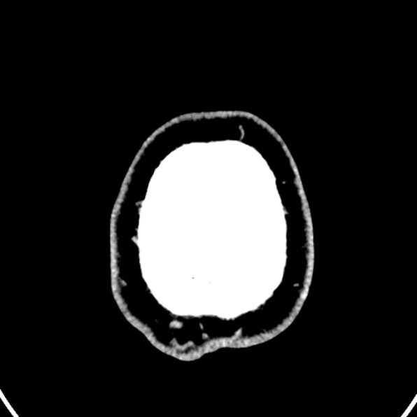 Cerebral arteriovenous malformation (Radiopaedia 37182-39012 Axial non-contrast 49).jpg