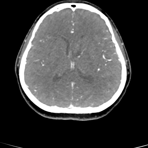 Cerebral arteriovenous malformation (Radiopaedia 73830-84645 B 45).jpg