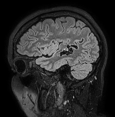 Cerebral arteriovenous malformation (Radiopaedia 74411-85654 Sagittal FLAIR 27).jpg
